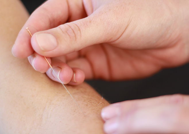 Dry needling or acupuncture for physiotherapy.